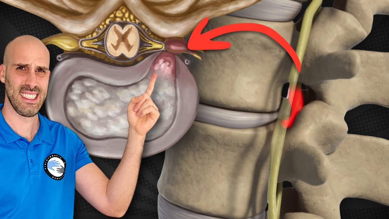 RUTINA de EJERCICIOS para la HERNIA DISCAL - 30 MINUTOS
