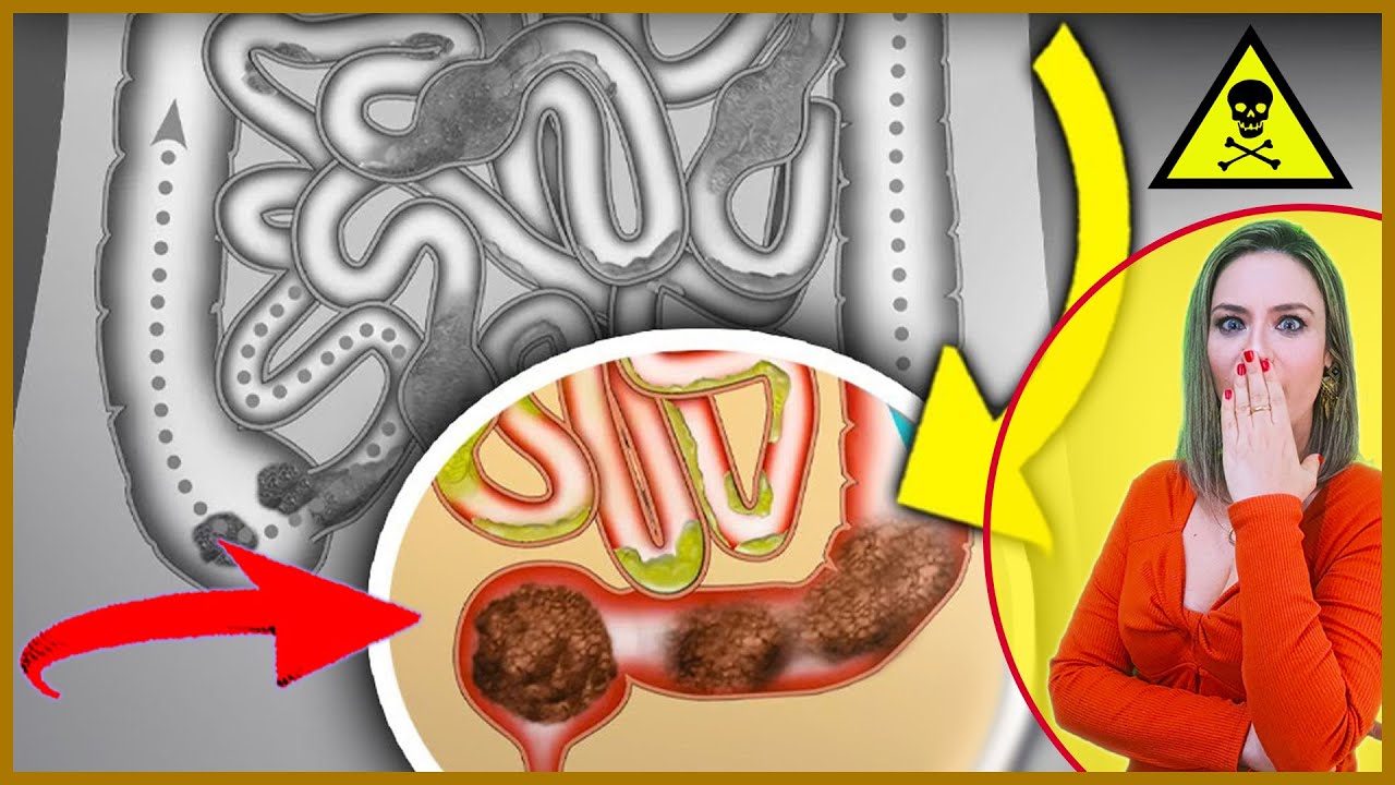 🟢ОЧИЩАЕТ КИШЕЧНИК 🎯 8 БЕСПРЕЦЕДЕНТНЫХ советов |🚽🧻 ДЕЙСТВУЕТ МГНОВЕННО | Не выходите из дома после...
