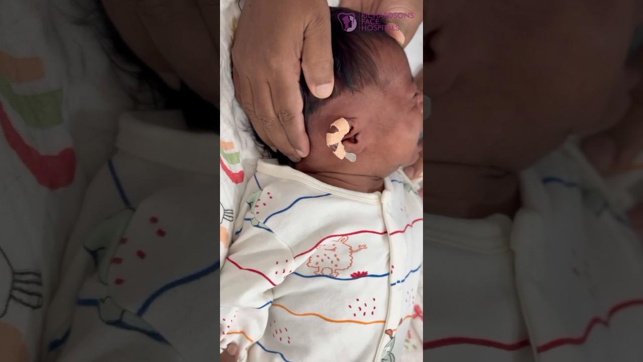 Did you know that EAR Moulding can Correct Deformities on shape soon after birth too.!