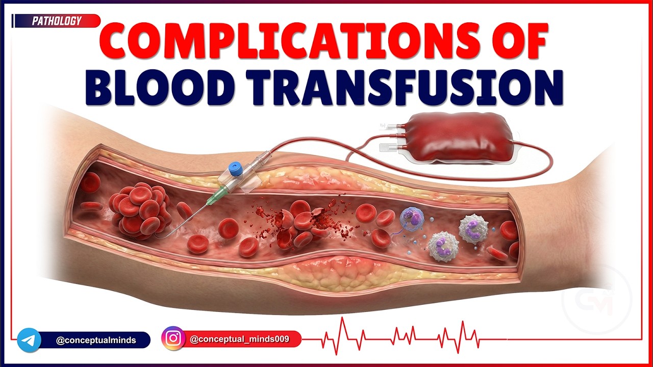 6. Complications of Blood Transfusion 🩸⚡ | Acute & Delayed Reactions Explained | Pathology