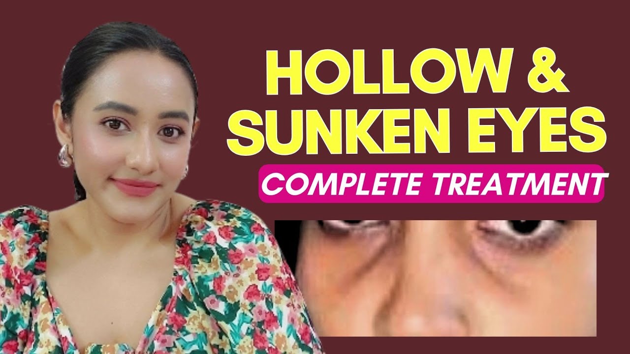 How to TREAT HOLLOW UNDER EYES OR SUNKEN UNDER EYES COMPLETELY. Skincare & Diet to treat Hollow eyes