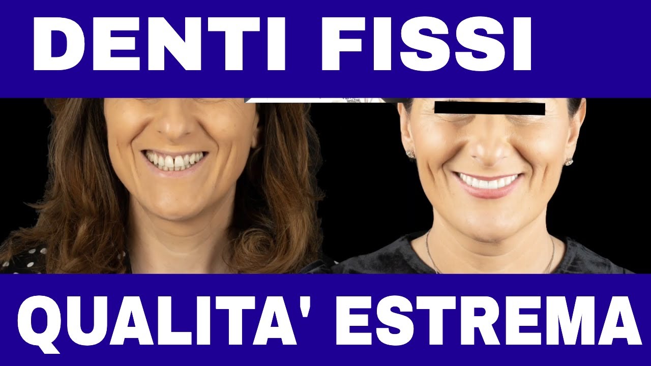 Denti Fissi con Qualità ESTREMA: BOCCA BIONICA