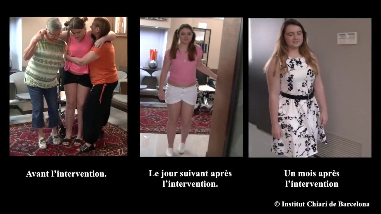 SNCV, Maladie du Filum, Syndrome d’Arnold Chiari I, Syringomyélie et Scoliose idiopathique.