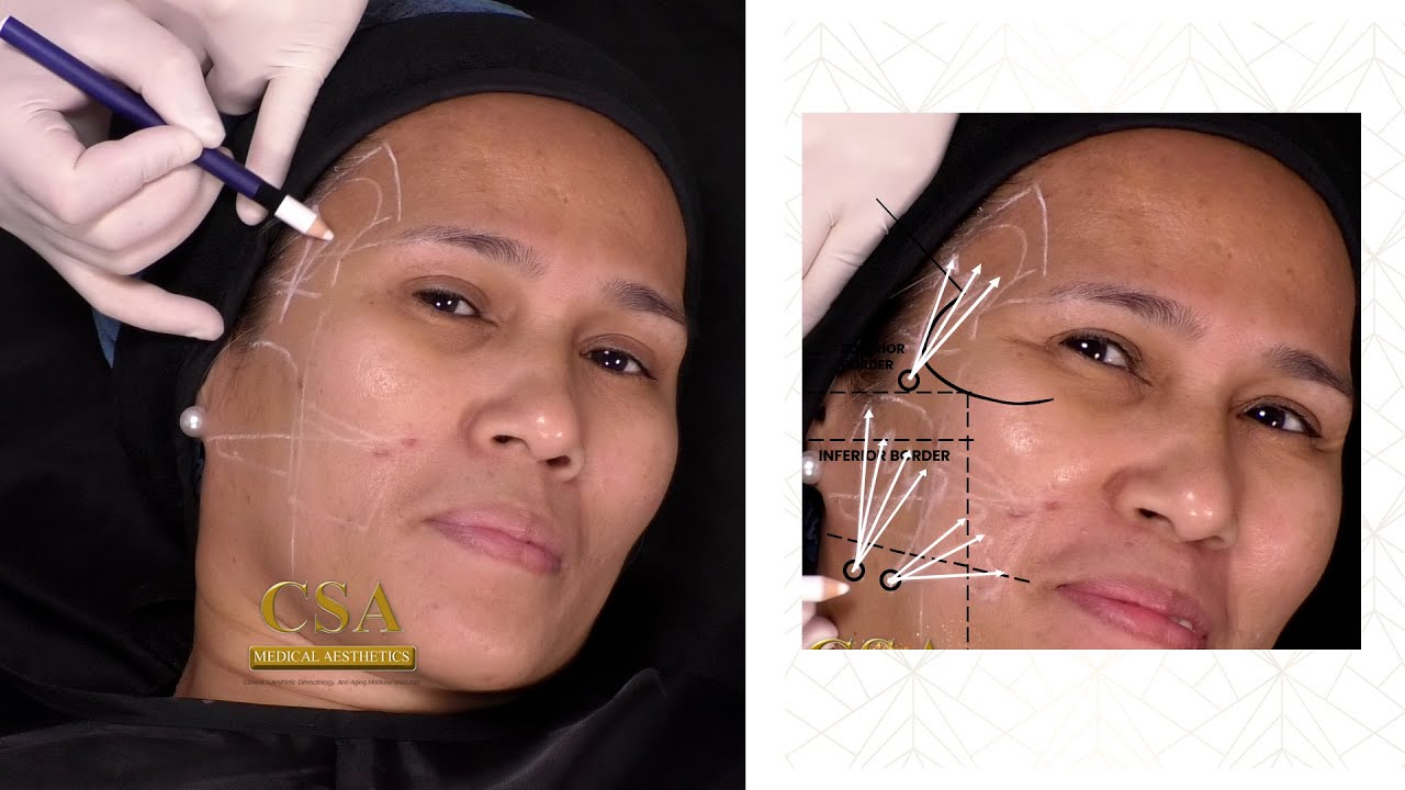 Restore youthful glow with sculptra