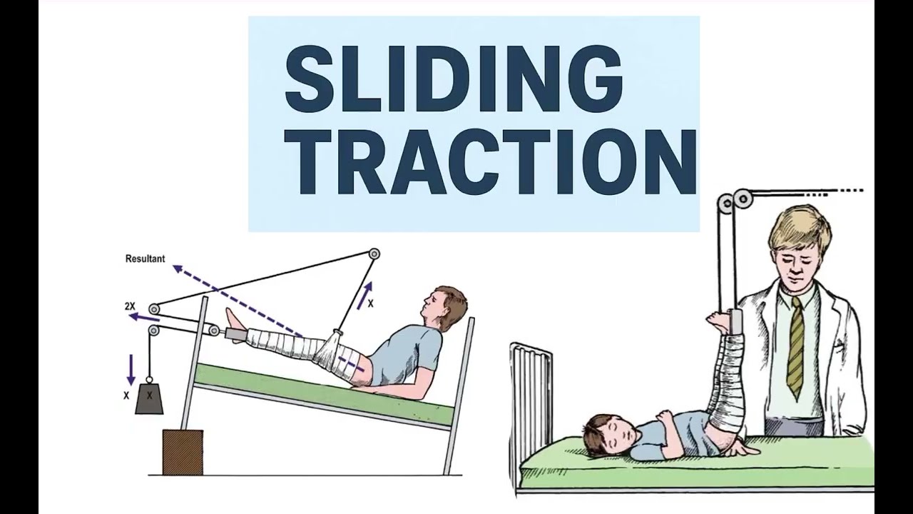 Sliding Tractions MASTERED: Buck's, Bryant's, Perkins & More!|Ortho Practical | DNB MS Ortho |