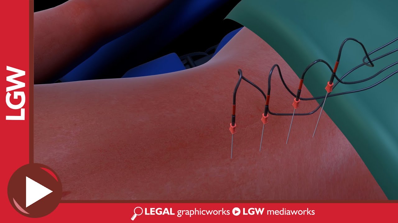 Lumbar Medial Branch Radio frequency Ablation 3D Animation
