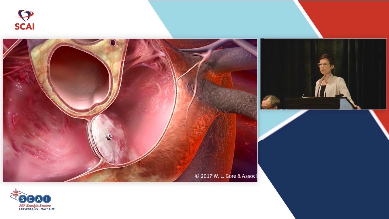 Why PFO Closure Is an Exciting Therapy
