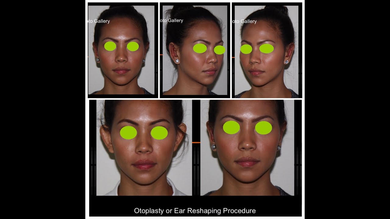 Otoplasty : Ear Reshaping Procedure