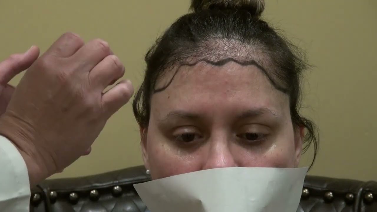 Female Hair Transplant Repair | Correcting Scalp Reduction & Poor Hairline Results