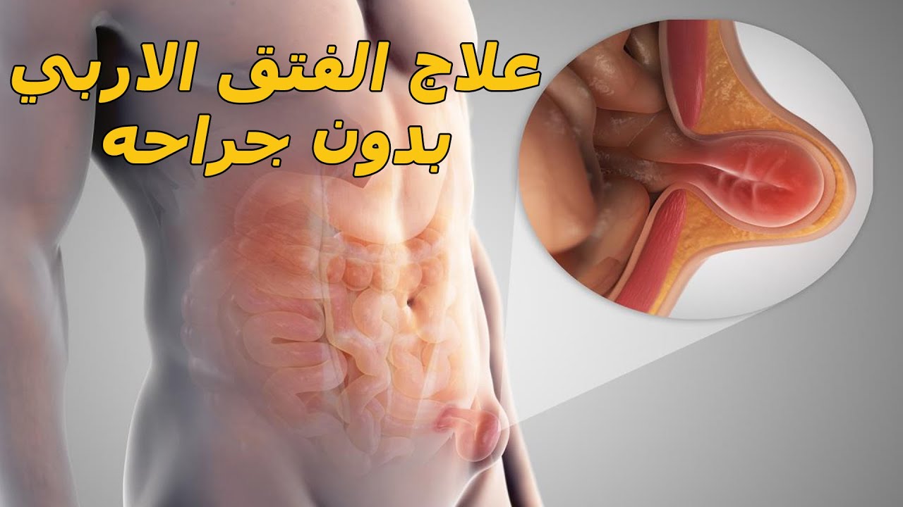 هل يعالج الفتق الاربي بدون جراحة؟/الفتق الاربي الاسباب والعلاج