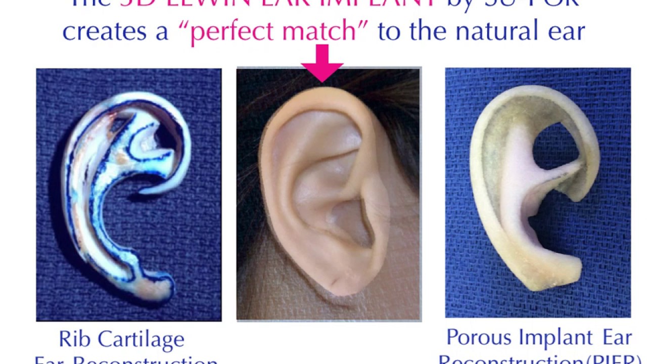 3D Lewin Ear Implant by SU-POR