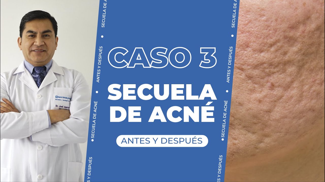 SUBCISION MULTINIVEL: avance de antes y después 😁