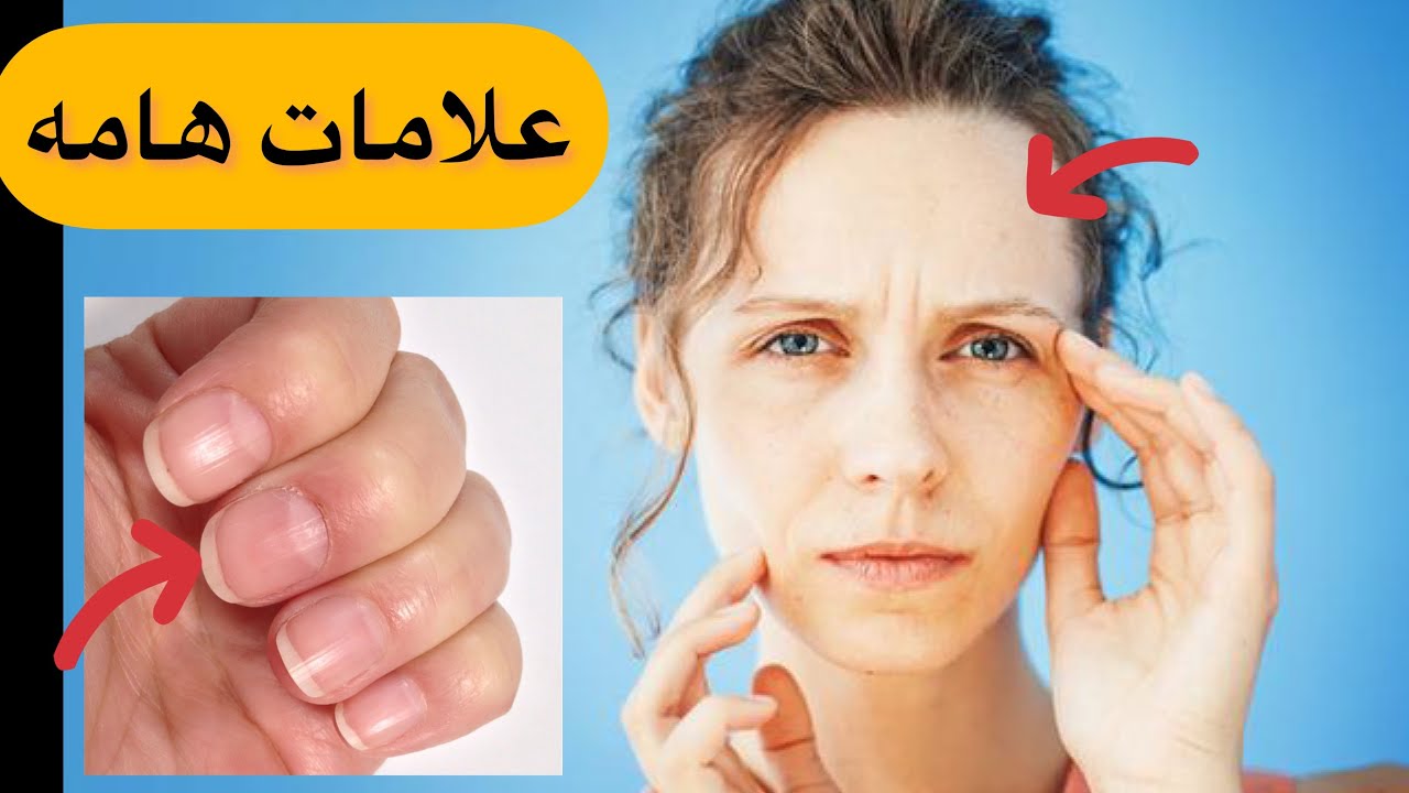فقر الدم و الانيميا ! هذه الفئات معرضه ل نقص الحديد ؟ اعراض الانيميا و اسباب تسمم الحديد ؟