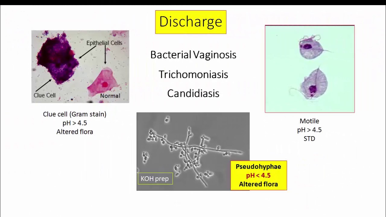 12DaysinMarch, Genital Infections for USMLE Step One
