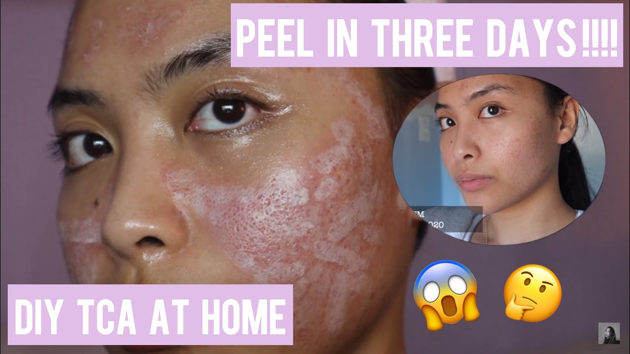 FIRST TIME DIY TCA 50% | DEMO&REVIEW | NO HYPERPIGMENTATION ‼️ | Feat. Banisher 2.0 |