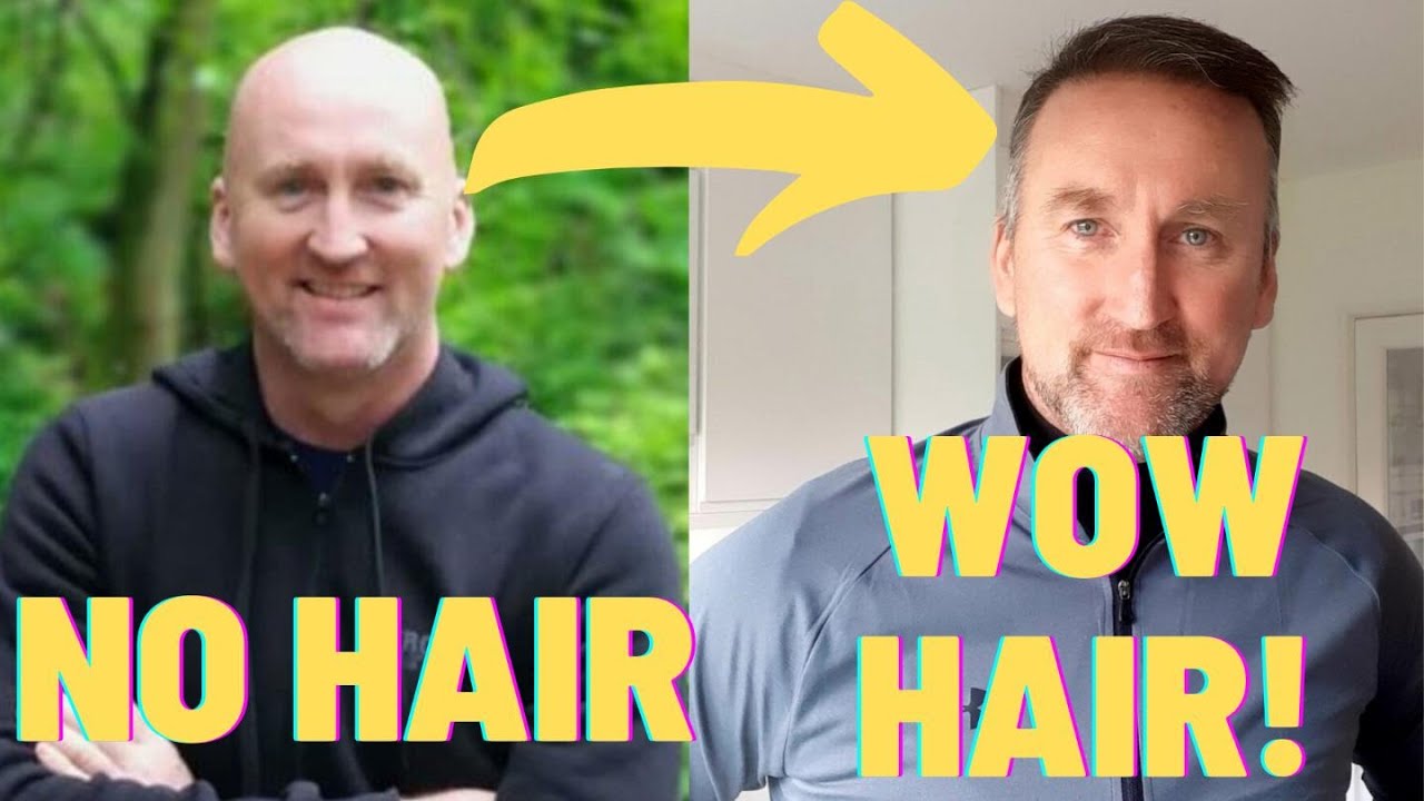 Norwood 6 Receives 7000 Grafts and Gets Life Changing Results