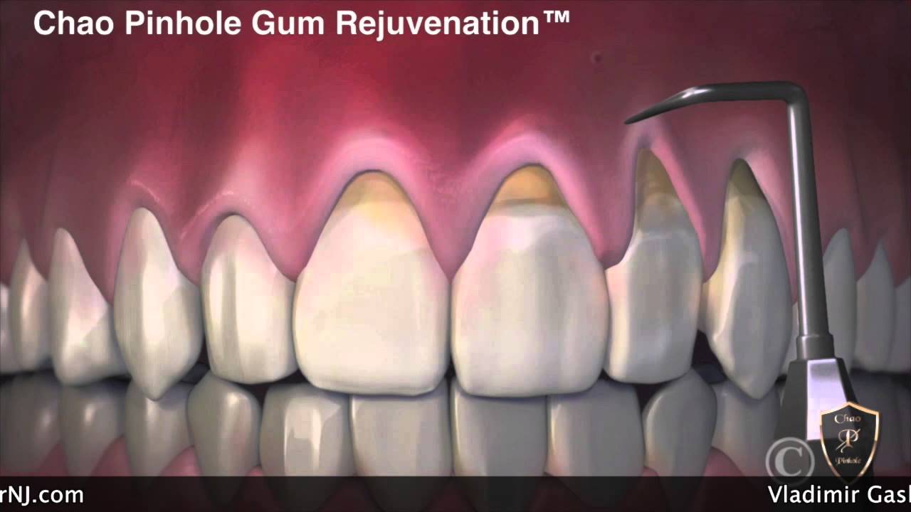 Chao Pinhole Gum Rejuvenation - Holistic Dental Center, New Jersey