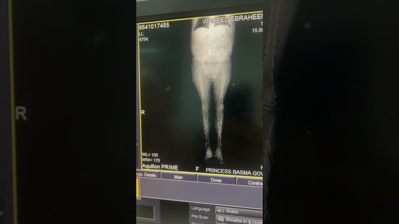 CTA LOWER LIMB ANGIOGRAPHY