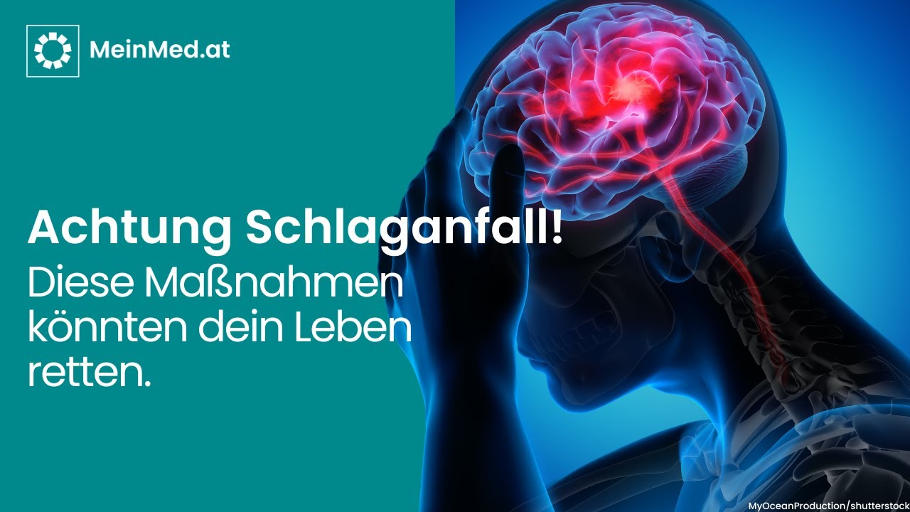 Schlaganfall vermeiden: Diese Ma&szlig;nahmen k&ouml;nnten dein Leben retten