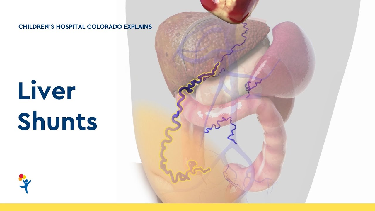 Portal Hypertension and Shunts in Children