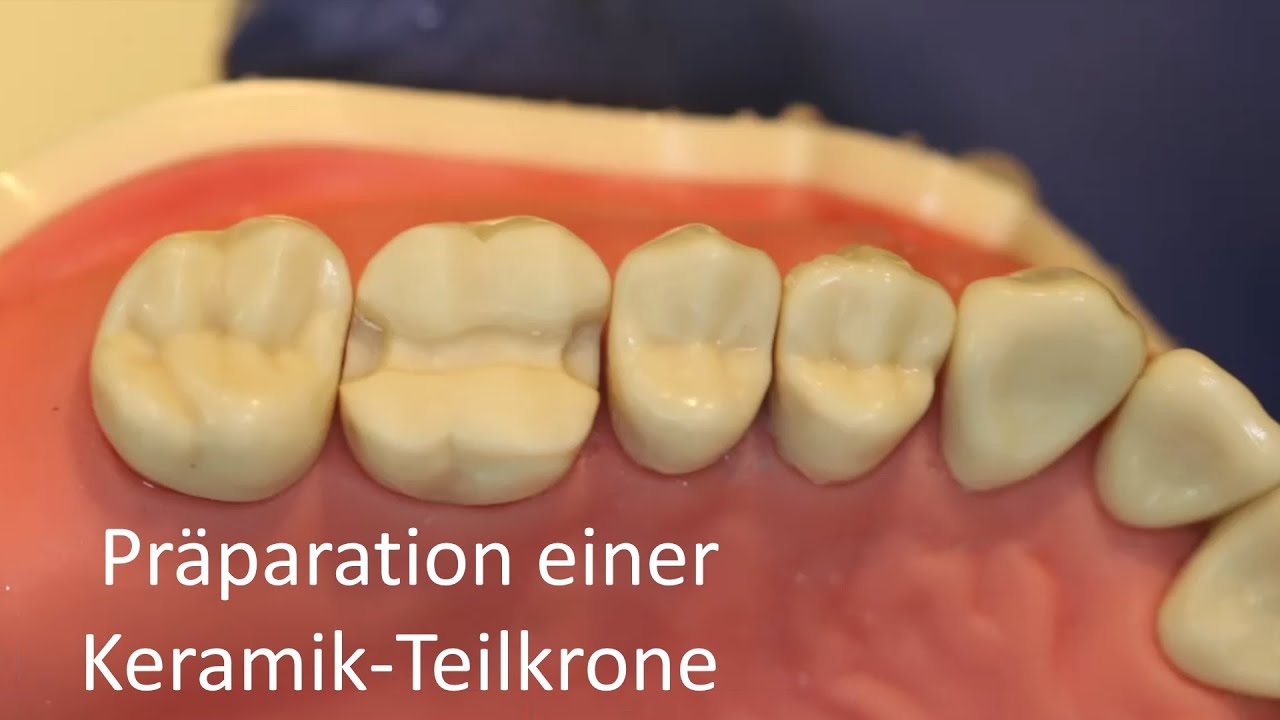 Präparation einer Keramik-Teilkrone
