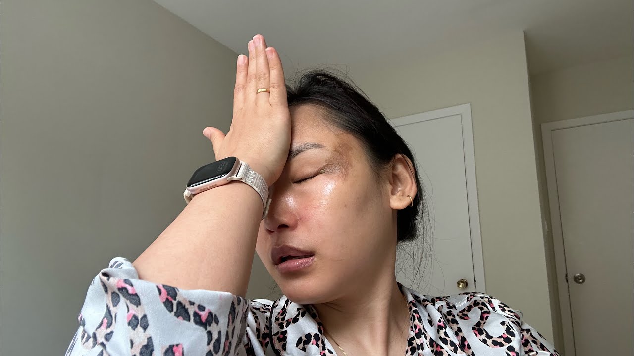 I BURNED MY FACE 🥵|| UPDATE #tibetanvlogger