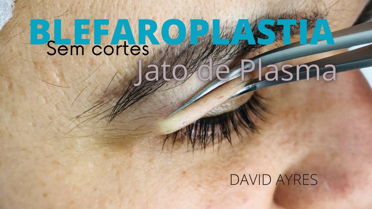 Blefaroplastias sem corte, com a caneta  portátil plasmed