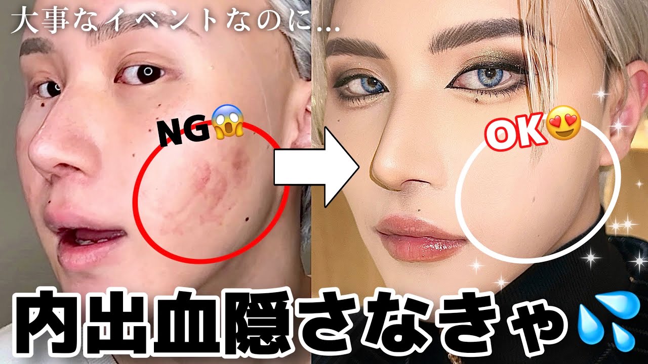 【案件なし】スワロイベント前なのに内出血ヤバッ😰💦メイクで跡形もなく消してやらァァァア‼️🔥