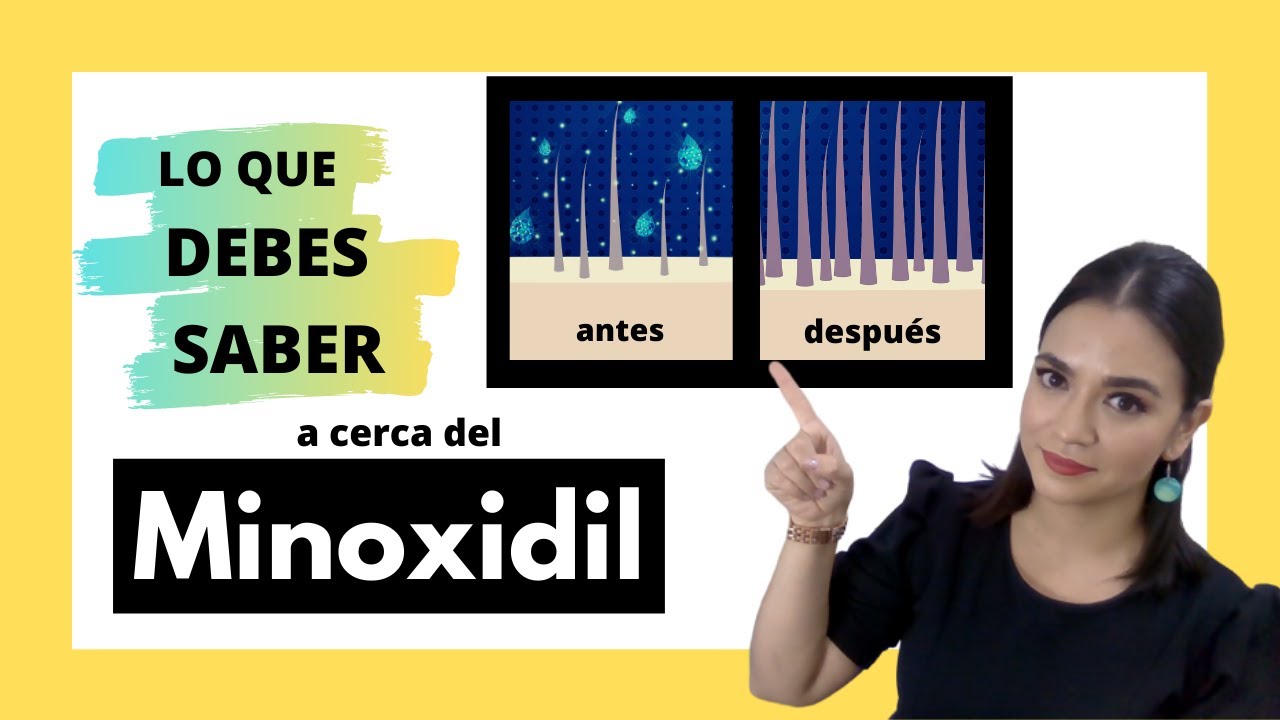 Lo que debes saber acerca del Minoxidil