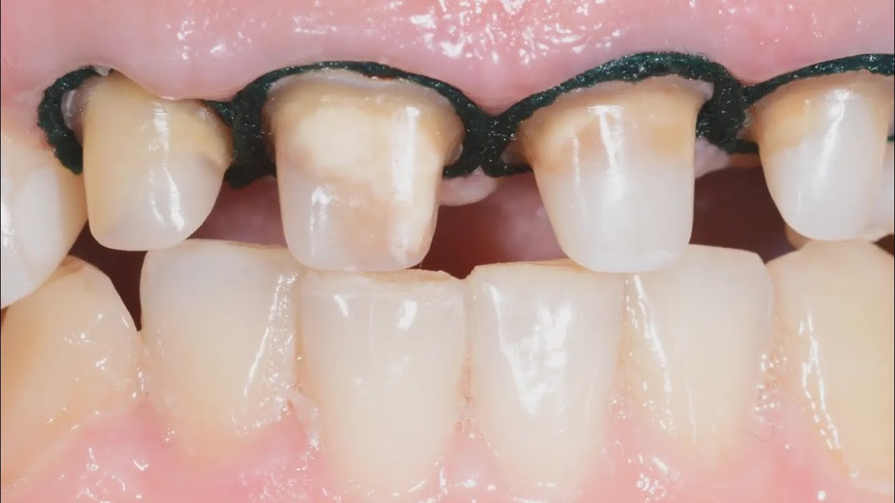 شرح مفصل لإلصاق تيجان زركونيا بالاسمنت الريزيني dual cure
