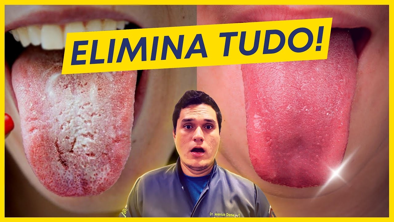 SABURRA LINGUAL: COMO ELIMINAR DE VEZ! (7 DICAS SIMPLES)