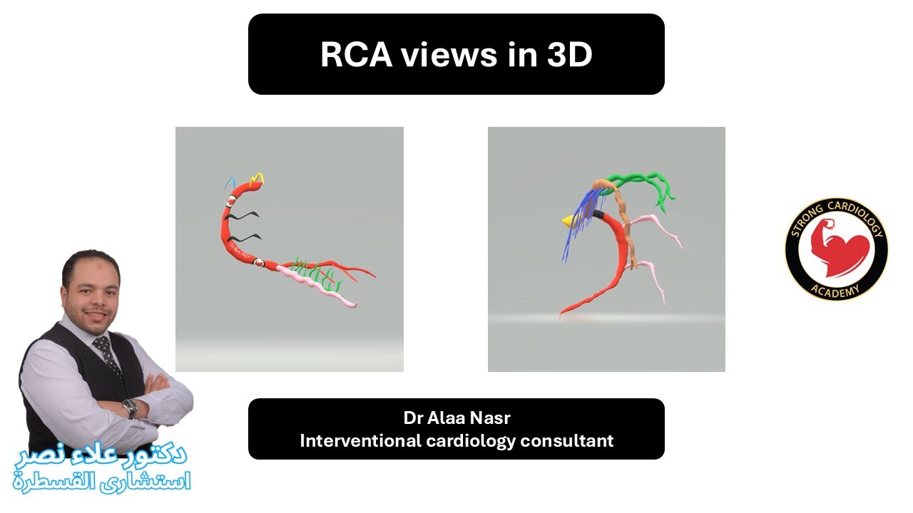 Coronary RCA angiographic views with 3D illustration, Dr Alaa Nasr, 2025