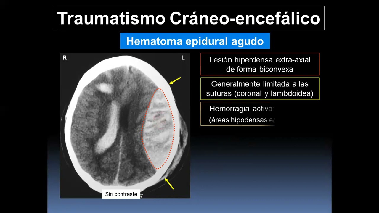 Diagnóstico por Imágenes en Patologías del Sistema Nervioso Central - Parte 1