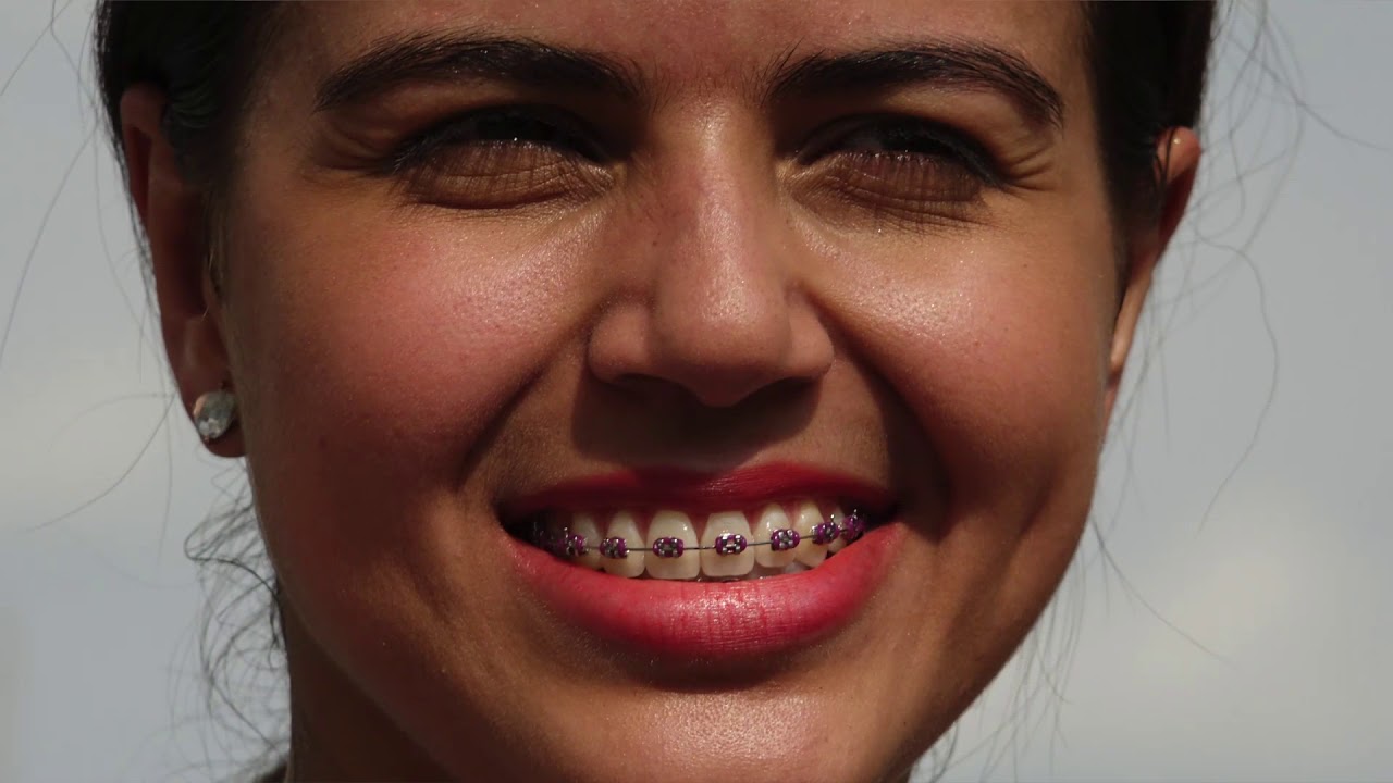 Can Invisalign Straighten My Teeth as Well as Braces?