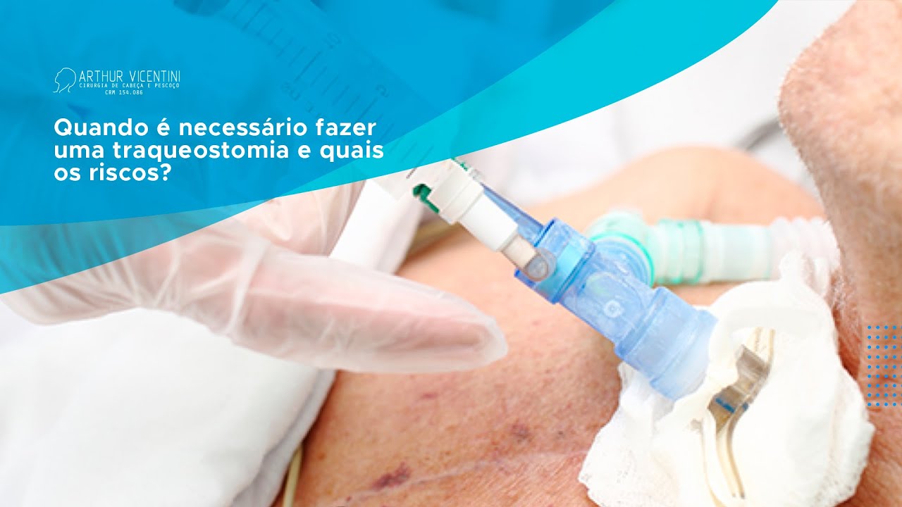 Quando é necessário fazer uma traqueostomia e quais os riscos? | Dr. Arthur Vicentini CRM 154.086