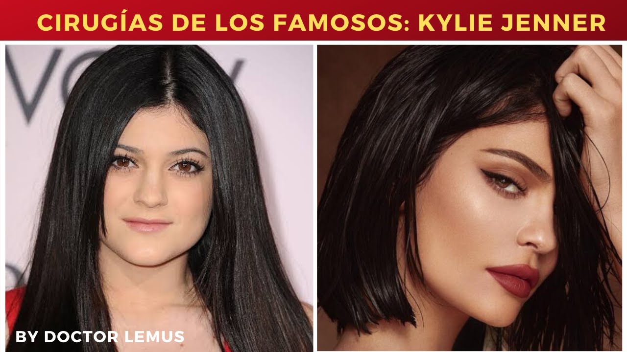CIRUGÍAS PLÁSTICAS DE KYLIE JENNER 😱 ¿QUE SALIO MAL?