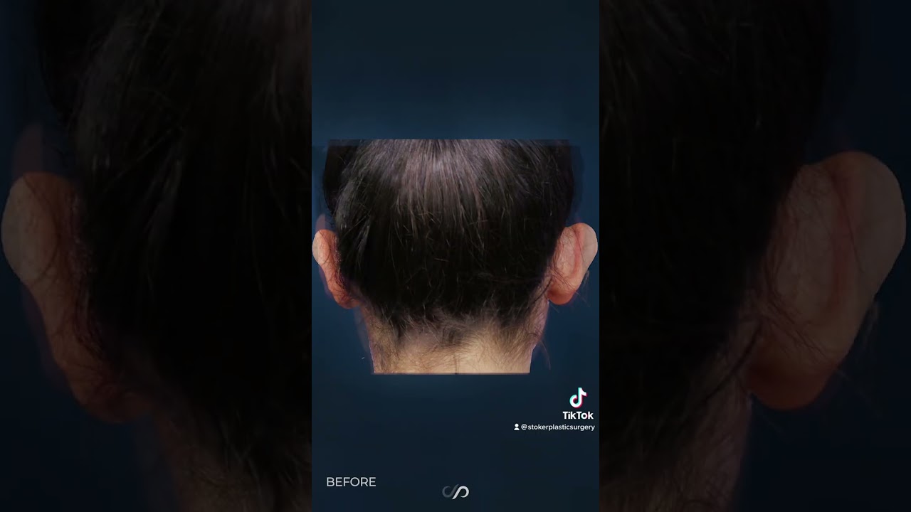 See the Incredible Transformation: Otoplasty Before and After Video