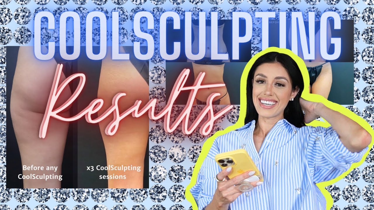 CoolSculpting Results ❄️ Before and After Photos 🥶, Vlog Part 3