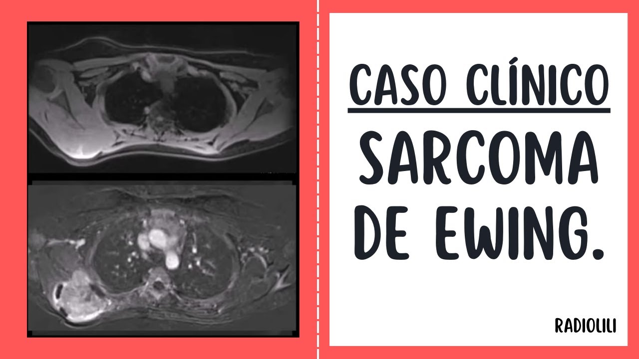 Caso Clínico 89: Sarcoma de Ewing.