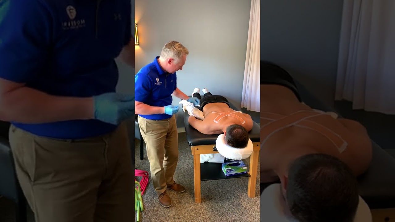 Dry Needling for the Rotator Cuff