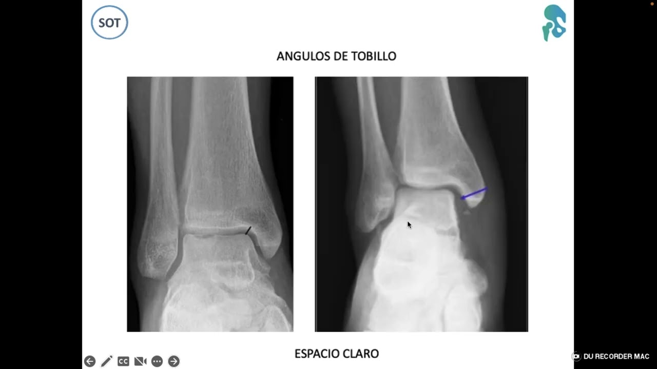 FRACTURAS DE TOBILLO