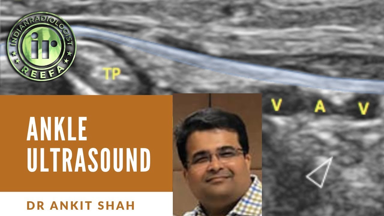 TMT: Ankle Ultrasound (3) by Dr Ankit Shah
