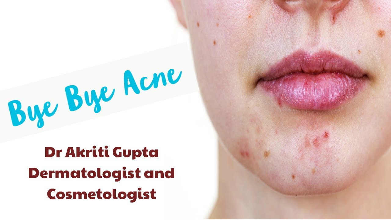 DO'S AND DONT'S IN ACNE BY DR. AKRITI GUPTA