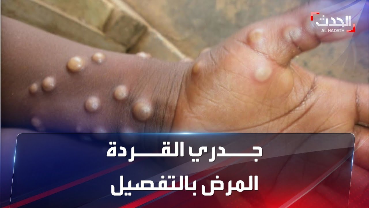 مرض قديم جديد يرعب العالم.. ما فيروس جدري القردة وأعراضه؟