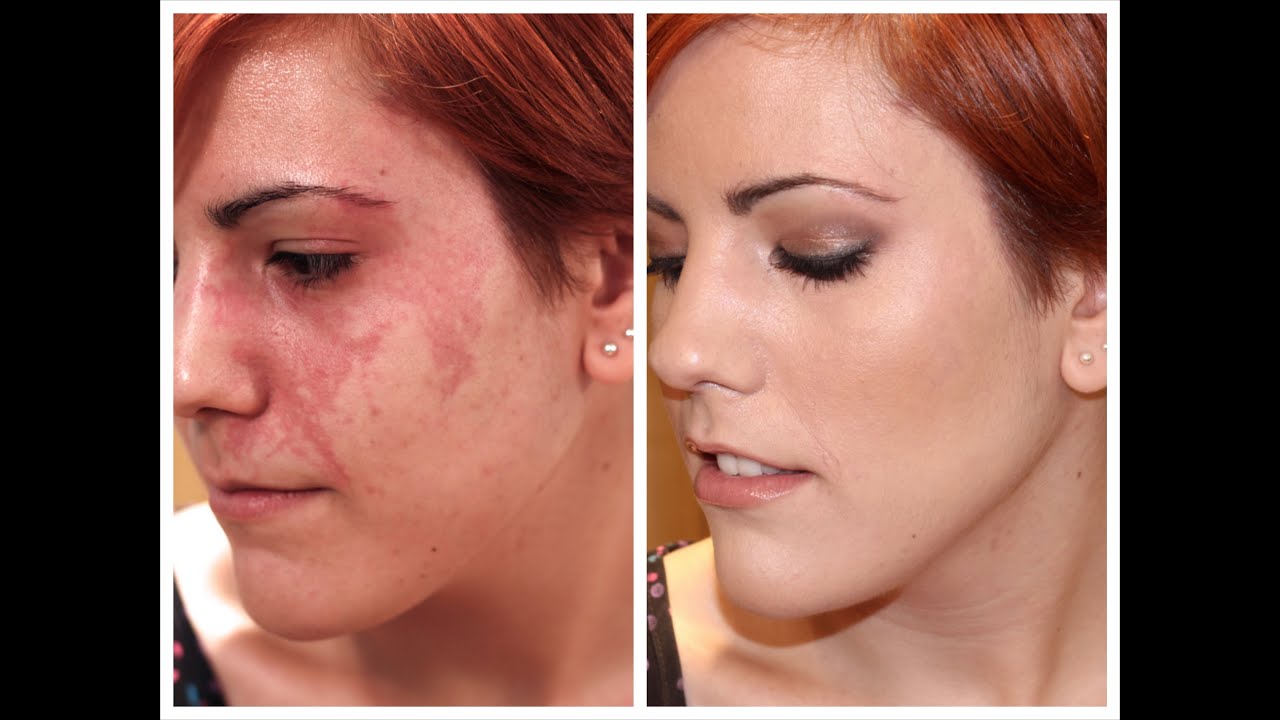 CÓMO CORREGIR ROJECES (ESPECIAL ANGIOMA) CON MAQUILLAJE
