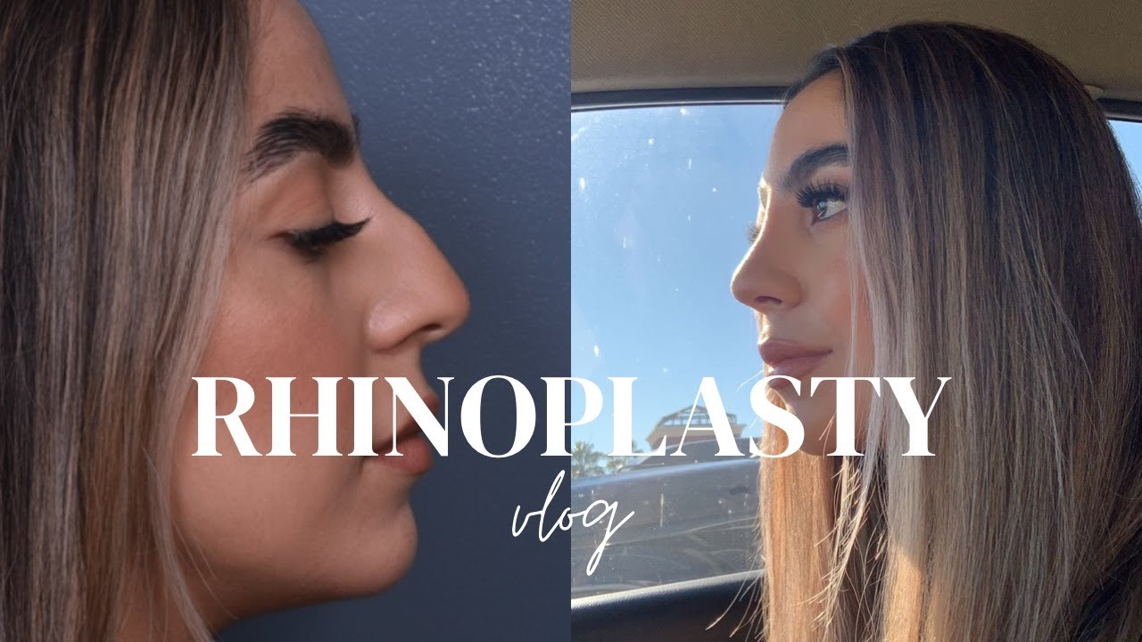 MY RHINOPLASTY WITH DR.VARTANY | VLOG