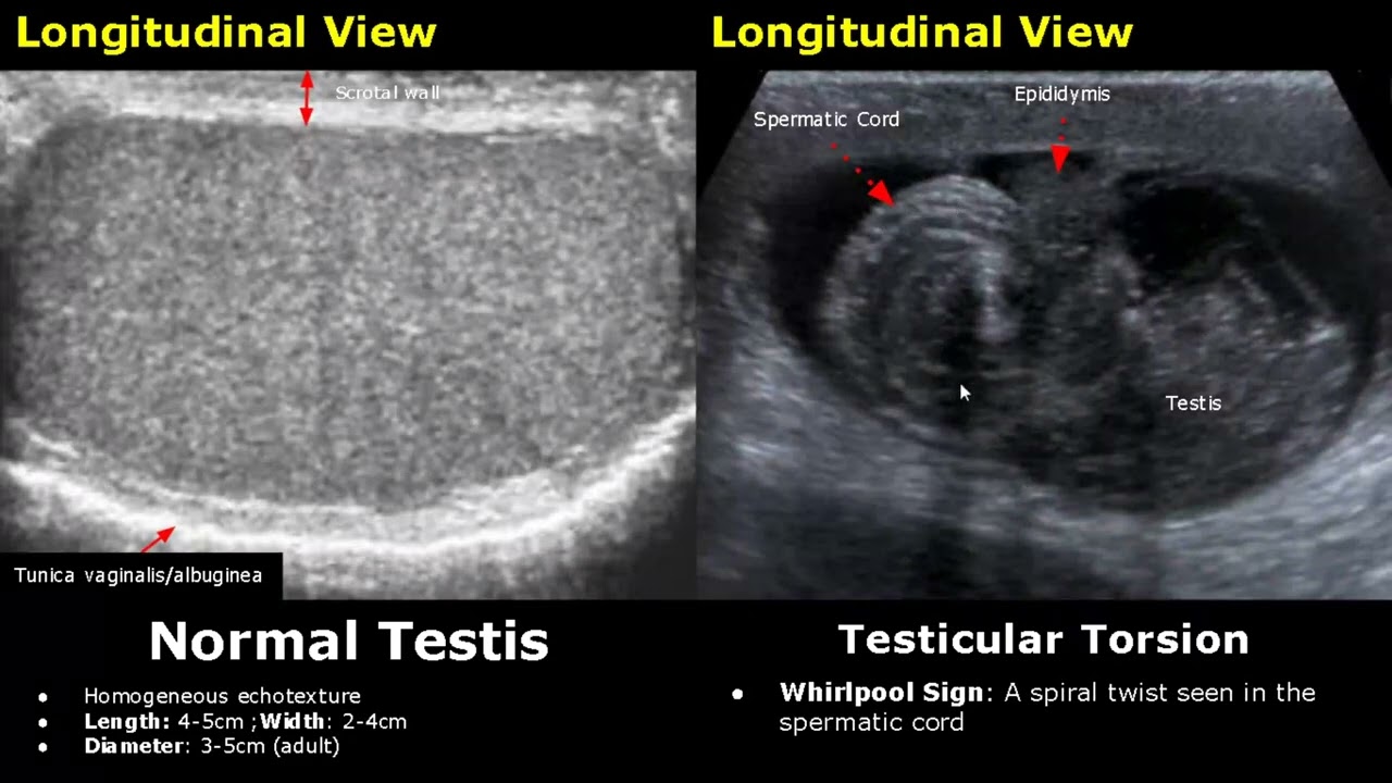 Scrotal Ultrasound Normal Vs Abnormal Image Appearances | Scrotum, Testis, Epididymis USG Scan