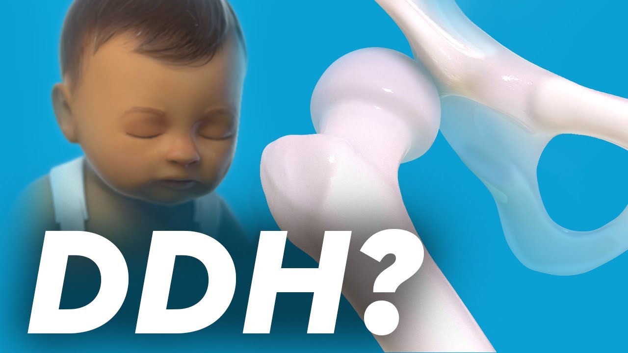 Developmental Dysplasia of the Hip