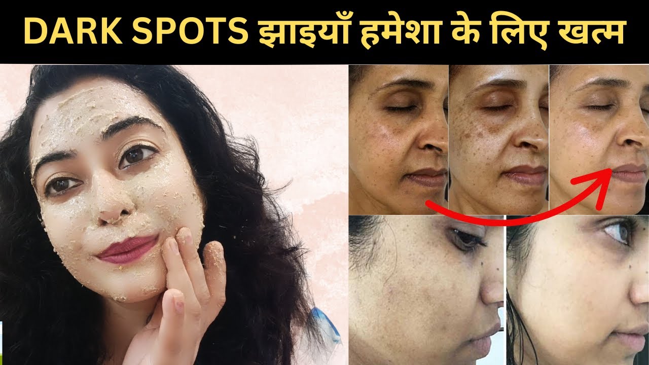 कितनी भी पुरानी झाइयां, Pigmentation जड़ से खत्म करें 100% रिजल्ट || How To Remove Pigmentation