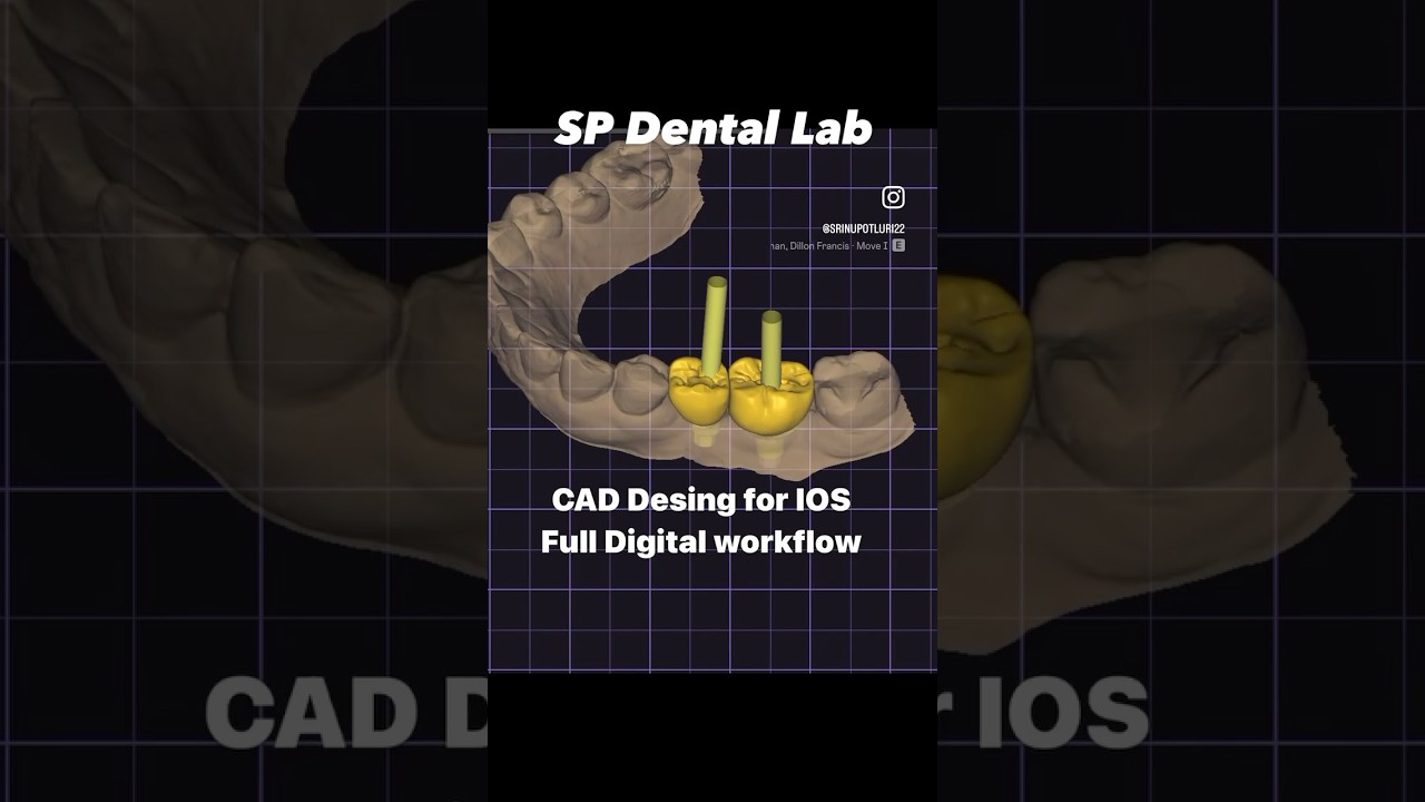 #emax #emaxveneers #implants #abutment #titanium #cadcamdental #milling #esthetic #dentalimplants